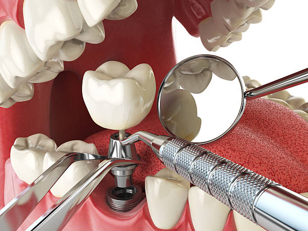 Urgent Tooth Repair in WA